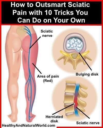 10 Tricks To Outsmart Sciatic Nerve Pain. Sciatic nerve pain relief may have eluded you up to ...jpg
