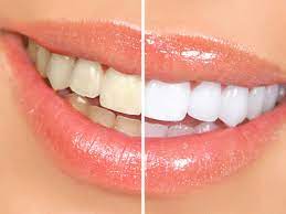 Diş Beyazlatma (Bleaching) - Ağız, Çene ve Diş Sağlığı - CENTRAL HOSPITAL