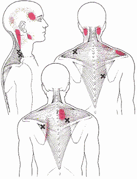 For neck and shoulder pain treatment, in addition to correcting any postural problems and revi...gif