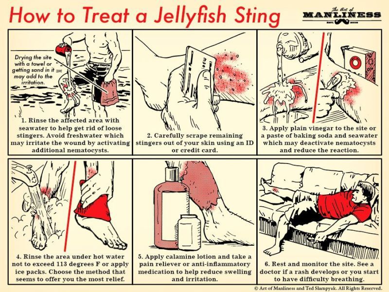 Guide how to treat a jellyfish sting.jpg