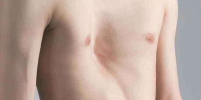 Pectus-Excavatum-660x330.jpg